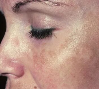 Leke serumu hangi renk lekeler için kullanılır?