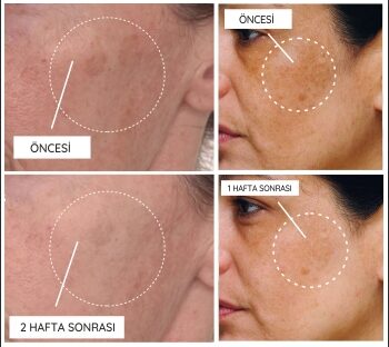 Leke serumu ne zaman lekeleri yok eder?